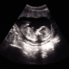 Documents Show Procuring Organs From Aborted Babies Cost $765 Each